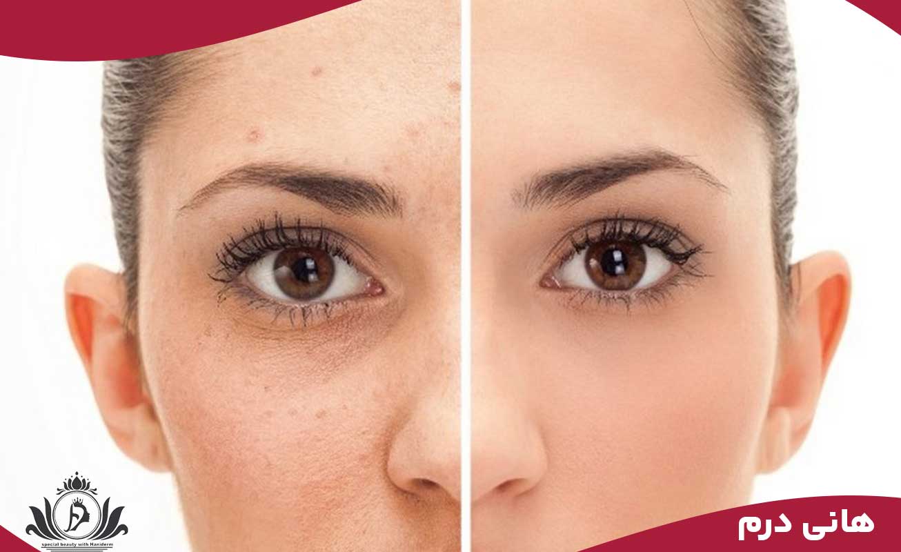 استرس و تاثیر آن بر پوست