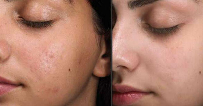 عکس قبل و بعد از پاکسازی پوست