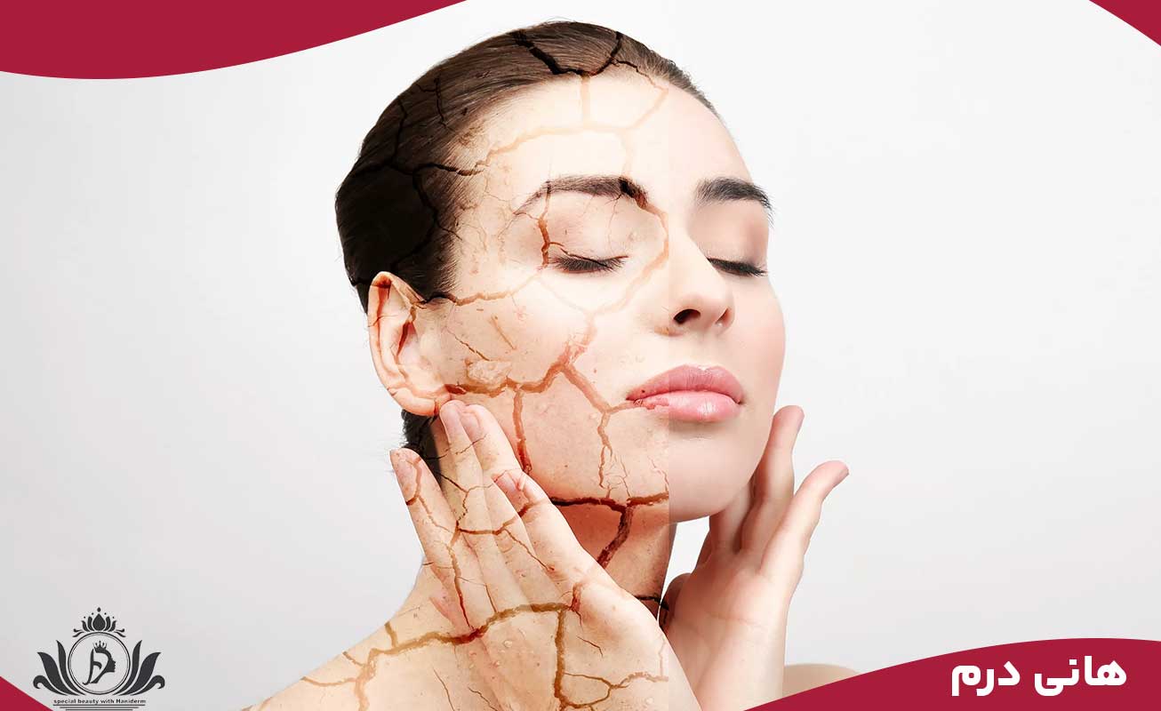 فیشیال پوست خشک و حساس