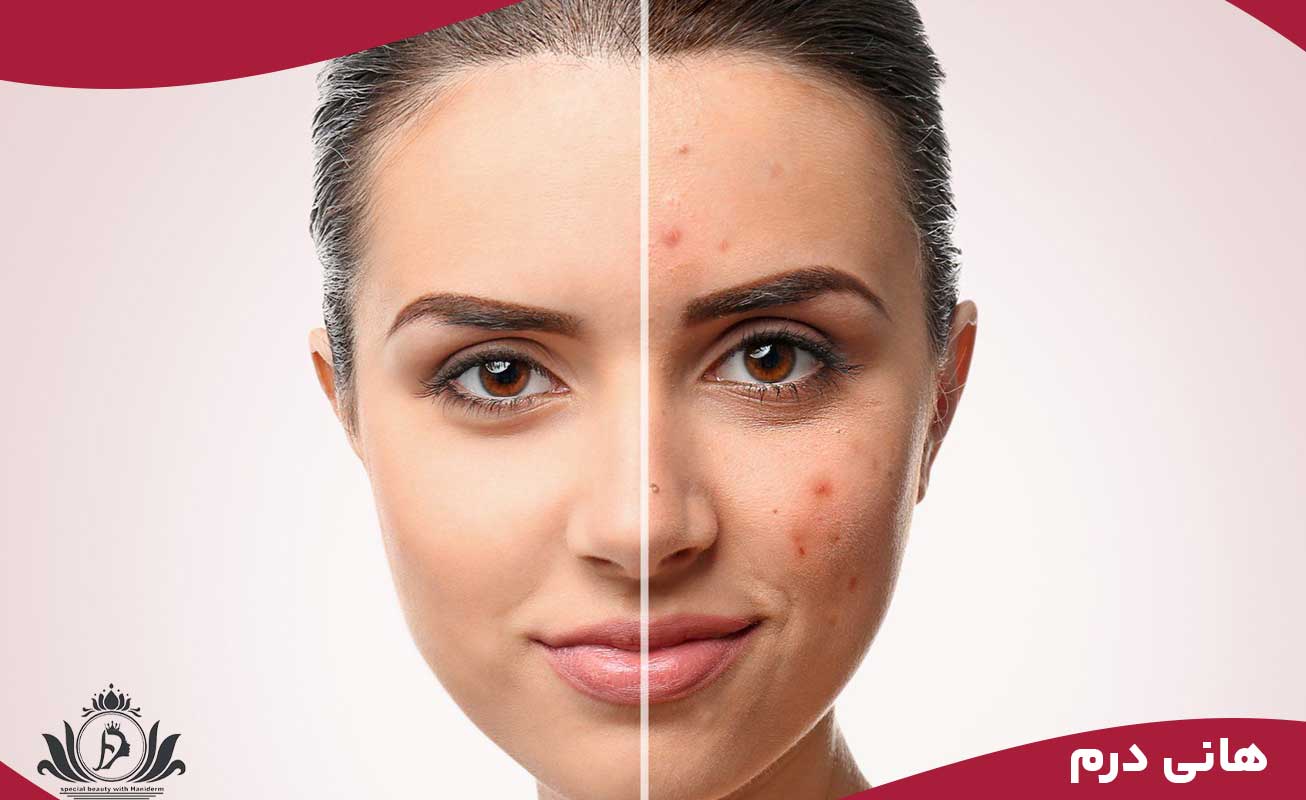 فیشیال پوست چرب