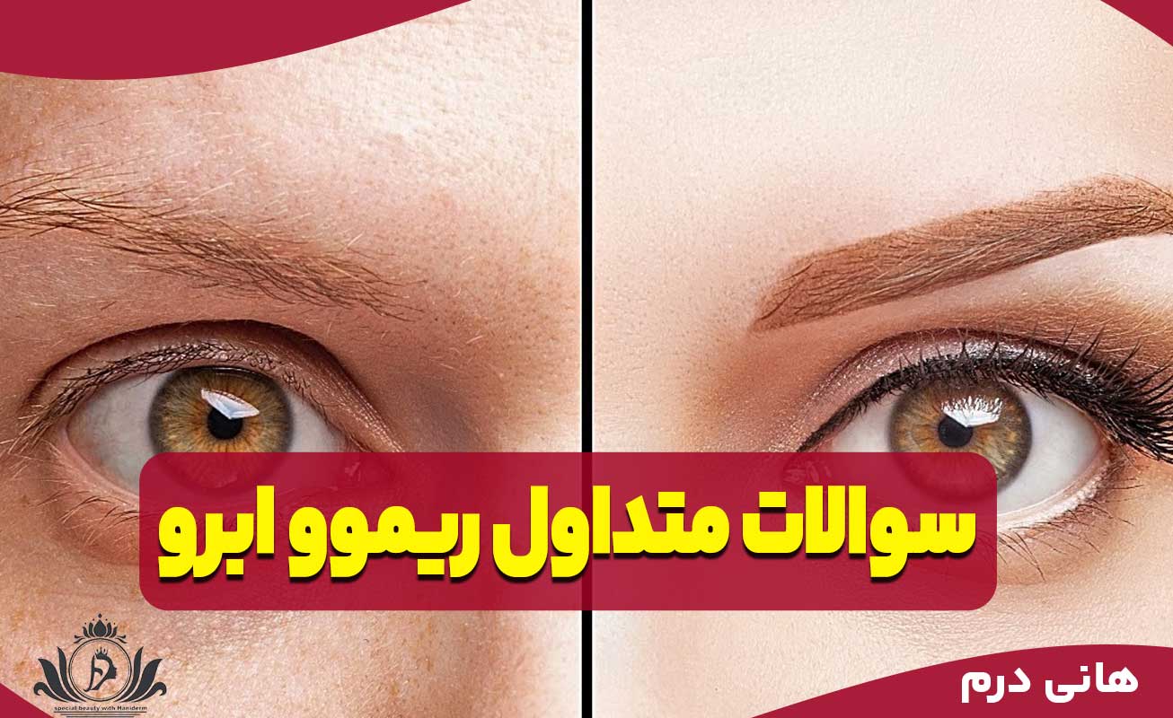 سوالات متداول ریموو ابرو