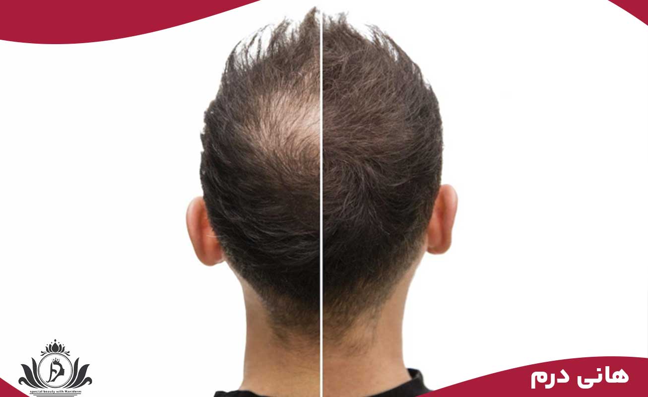 خارش و التهاب پساز اسکالپ سر