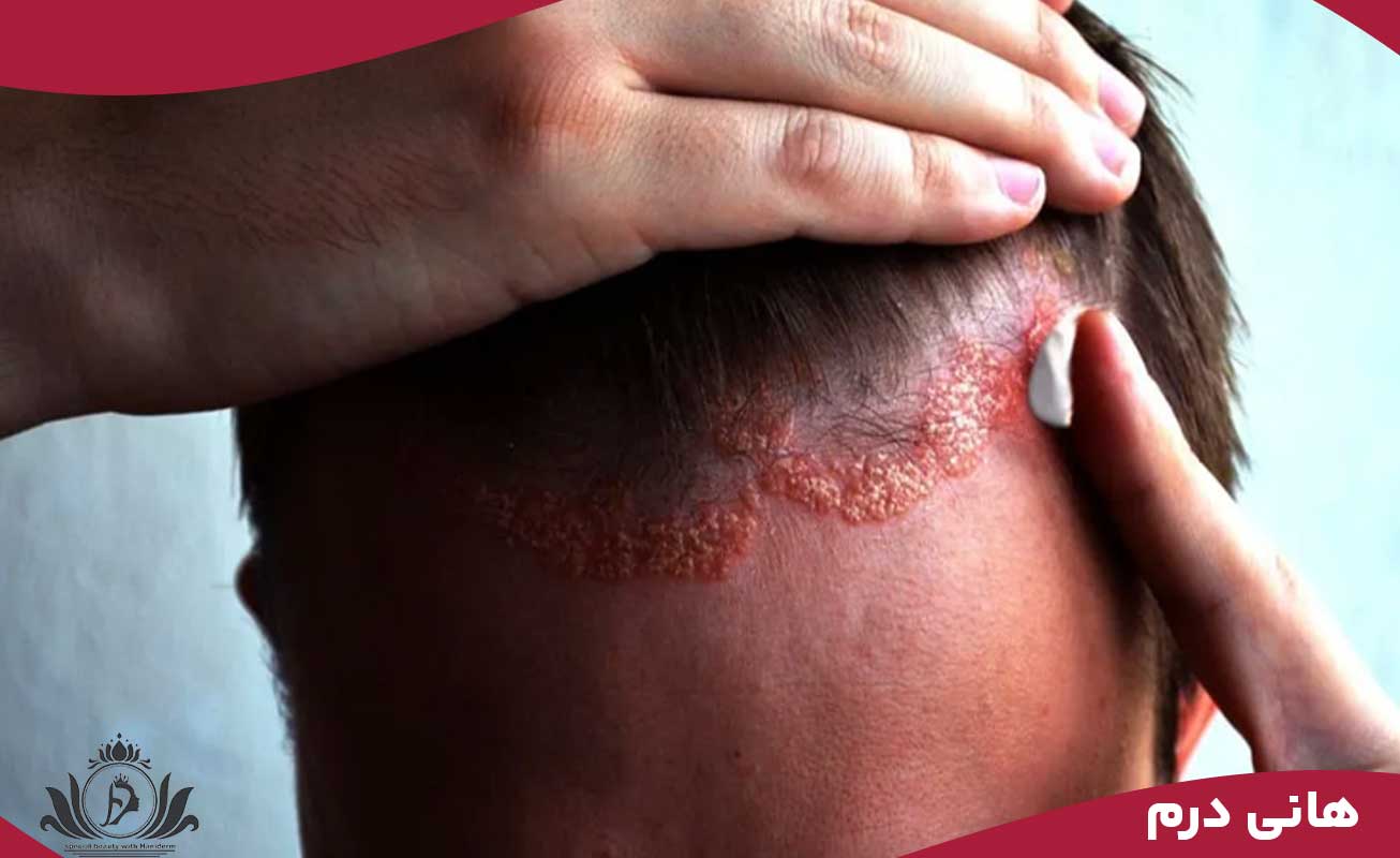 عفونت و واکنشهای آلرژیک