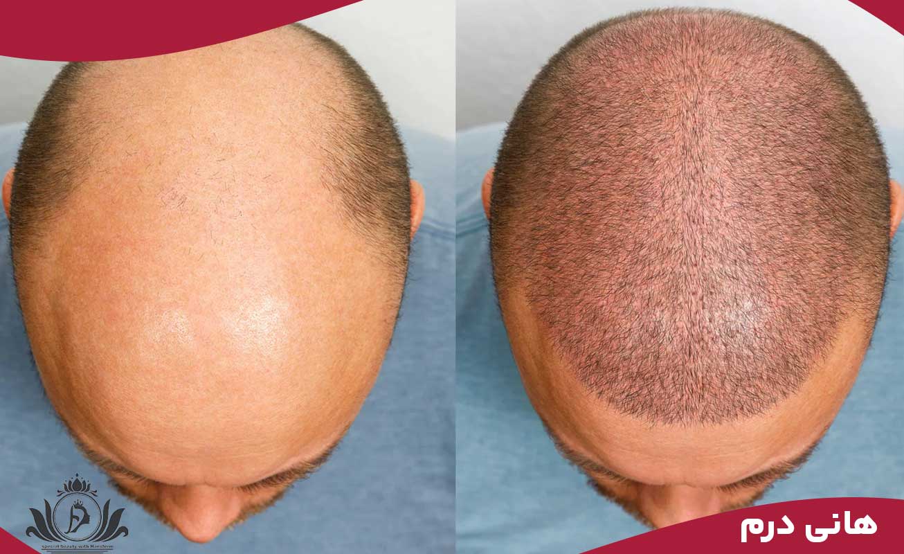 عوامل موثر بر هزینه اسکالپ سر