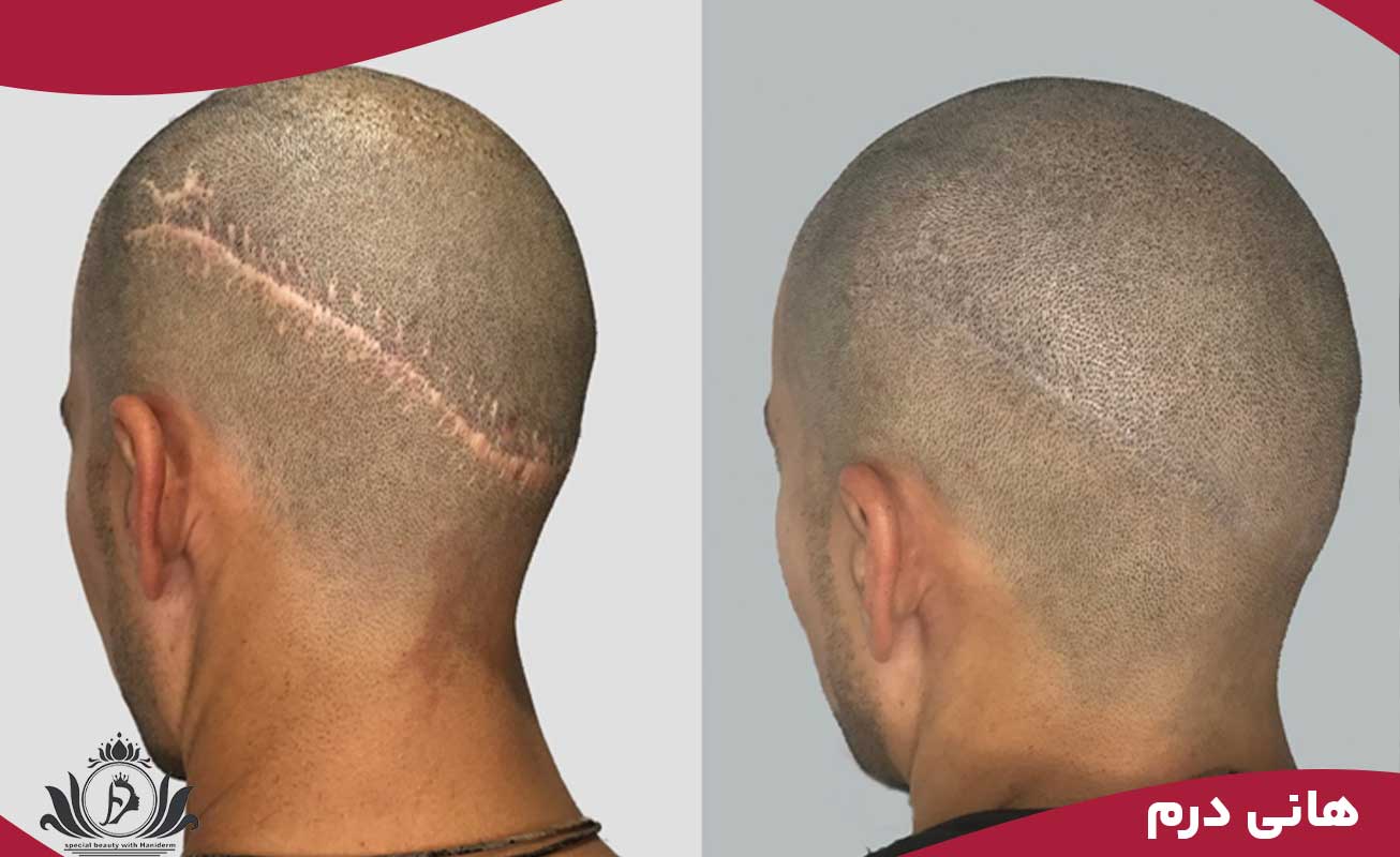 مقایسه هزینه و ویژگی‌های روش‌های ترمیم و بازسازی مو