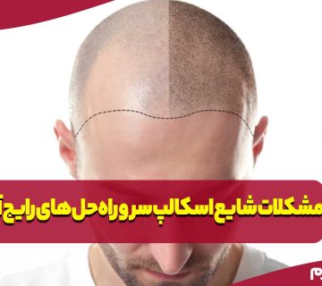 مشکلات شایع اسکالپ سر