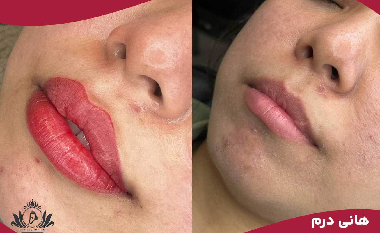 مراحل اجرای شیدینگ لب