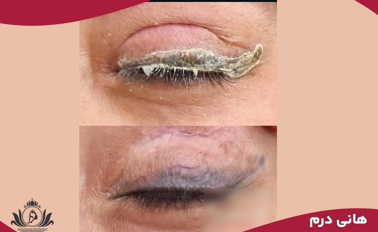 دوره آموزش ریموو بن مژه با مواد
