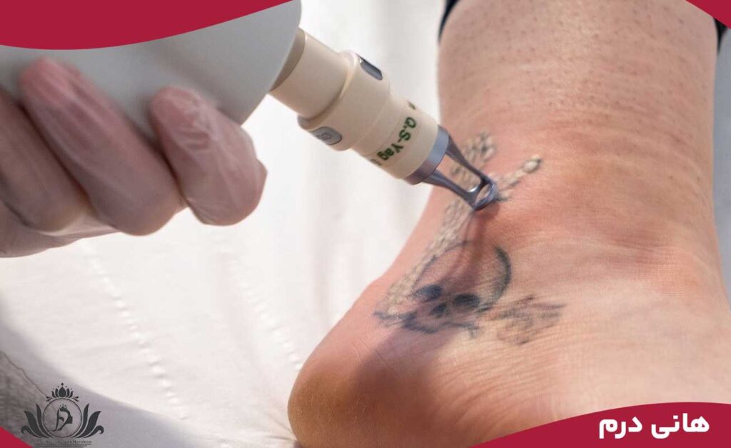 دوره آموزش ریموو تاتو بدن