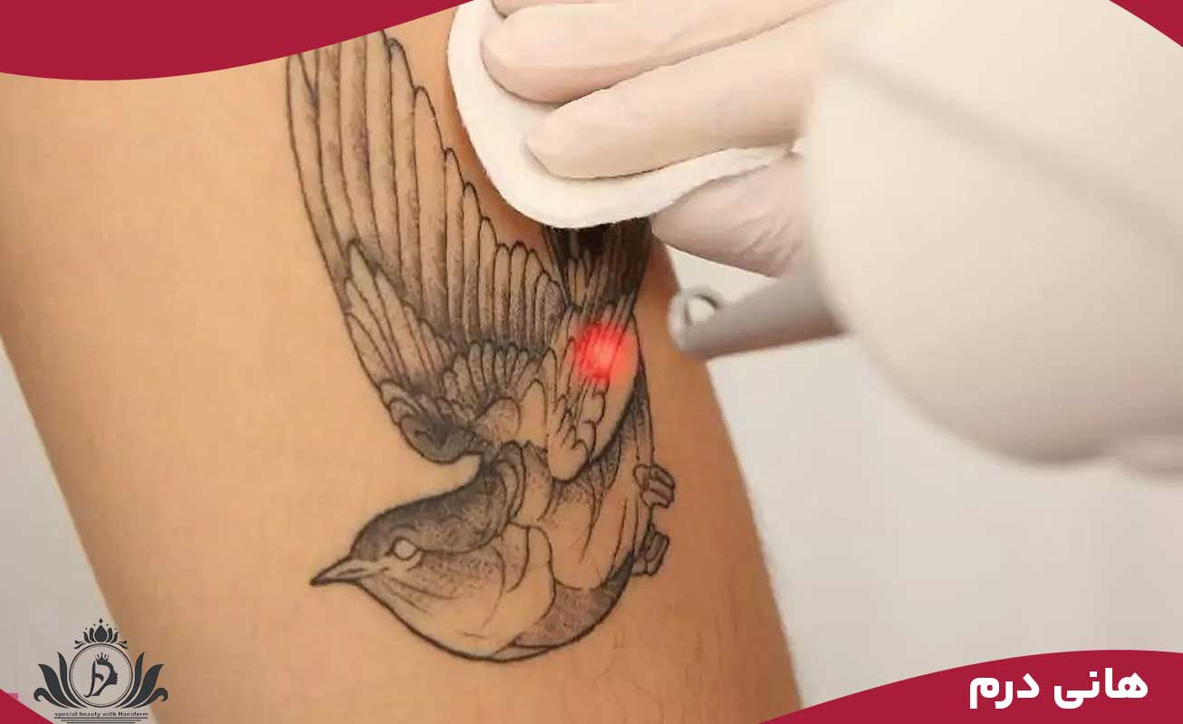 آموشگاه ریموو تاتو بدن