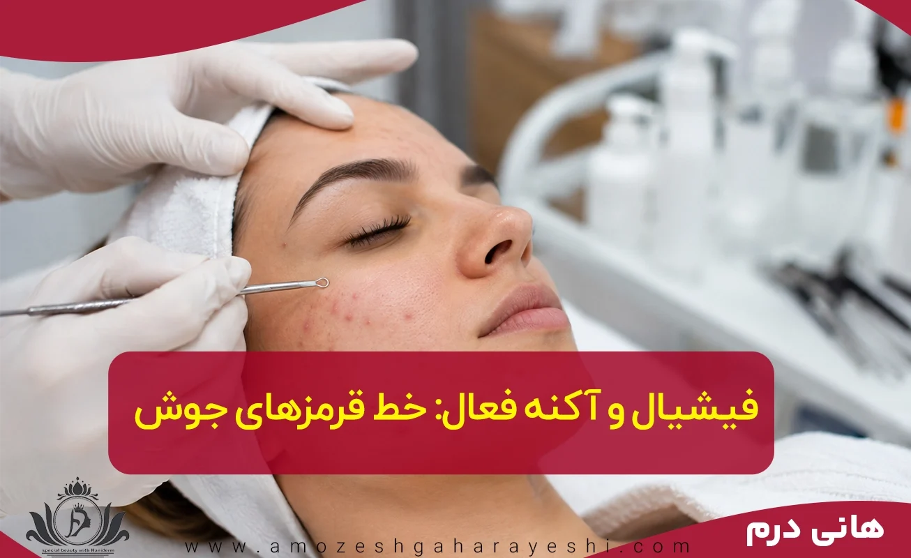 فیشیال برای آکنه فعال